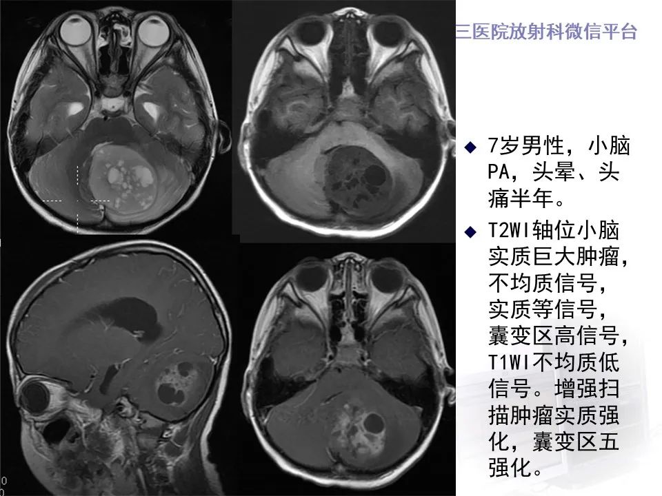 影像PPT - 【病例】四脑室毛细胞型星形细胞瘤1例MR影像-26