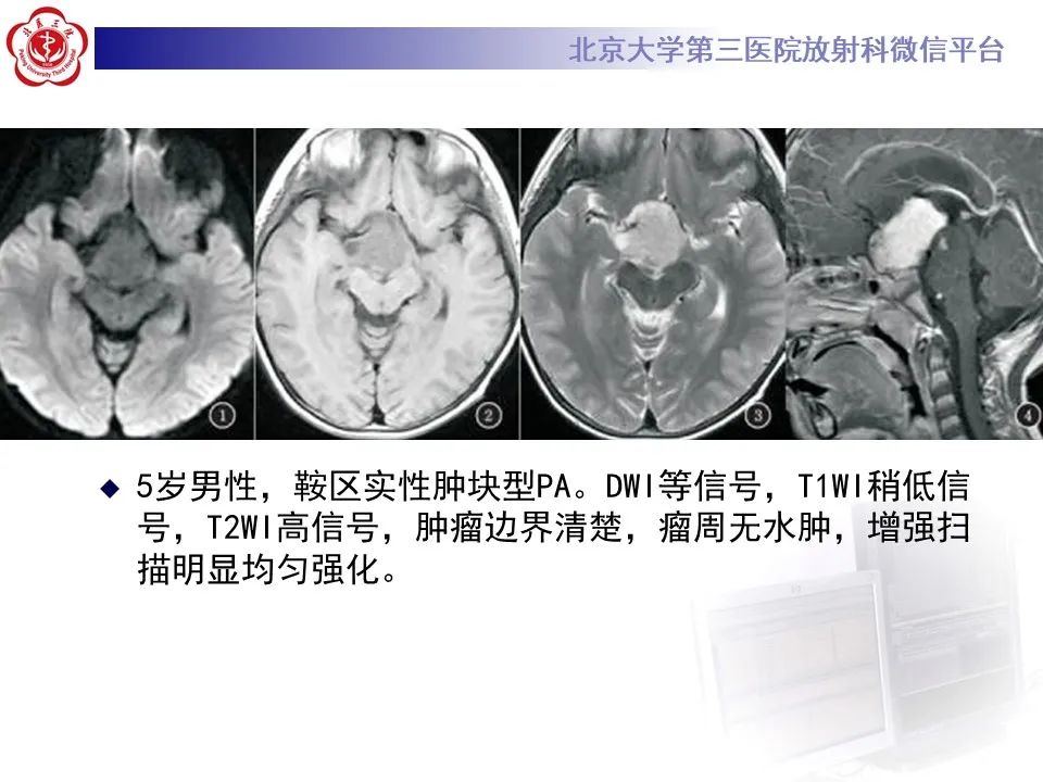 影像PPT - 【病例】四脑室毛细胞型星形细胞瘤1例MR影像-27