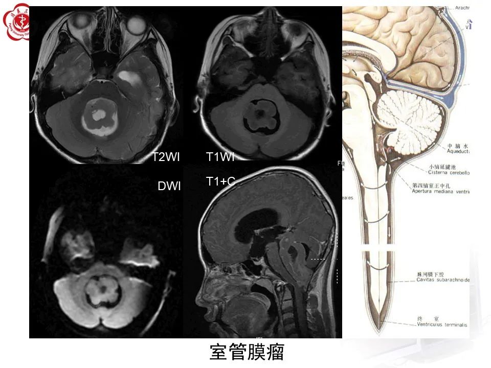 影像PPT - 【病例】四脑室毛细胞型星形细胞瘤1例MR影像-30