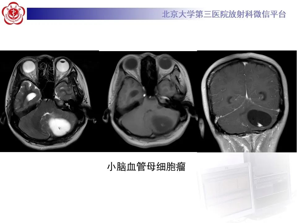影像PPT - 【病例】四脑室毛细胞型星形细胞瘤1例MR影像-32