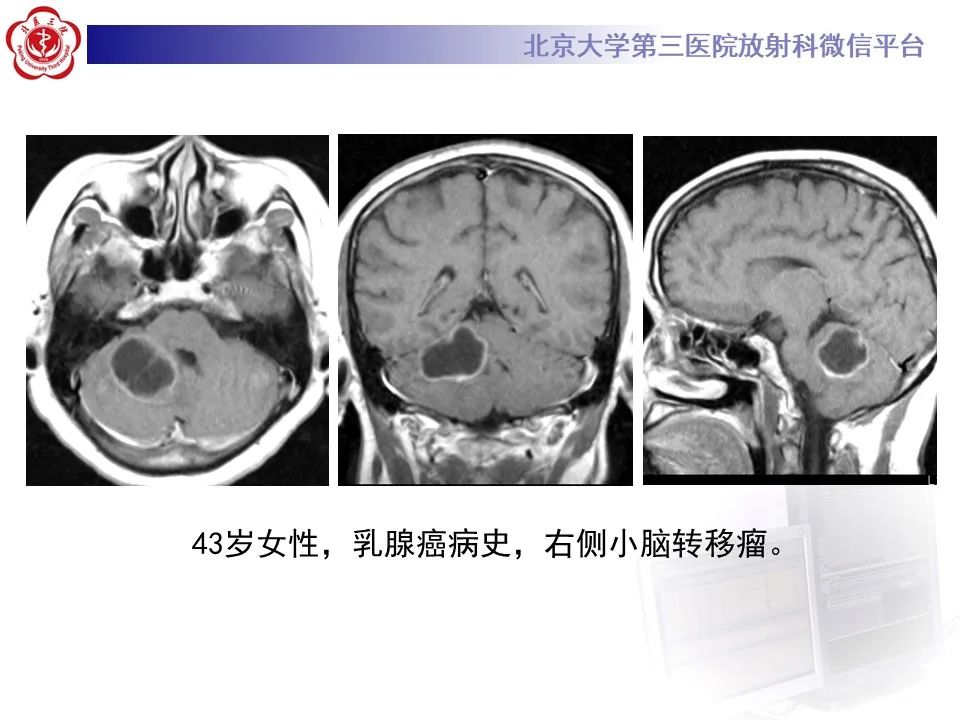 影像PPT - 【病例】四脑室毛细胞型星形细胞瘤1例MR影像-34