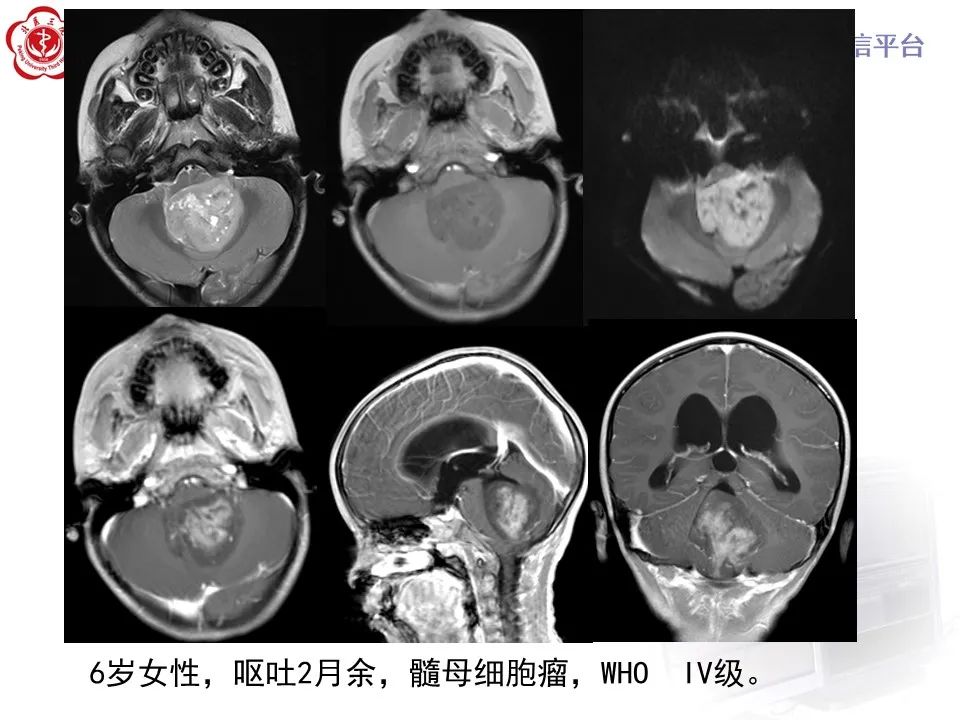 影像PPT - 【病例】四脑室毛细胞型星形细胞瘤1例MR影像-36