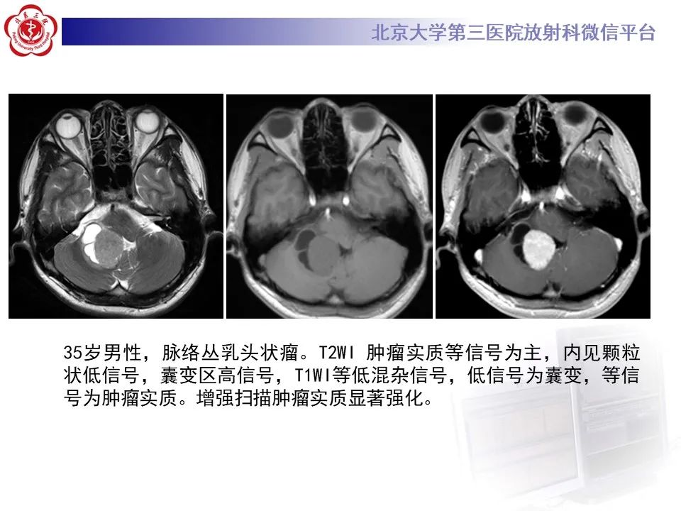 影像PPT - 【病例】四脑室毛细胞型星形细胞瘤1例MR影像-38