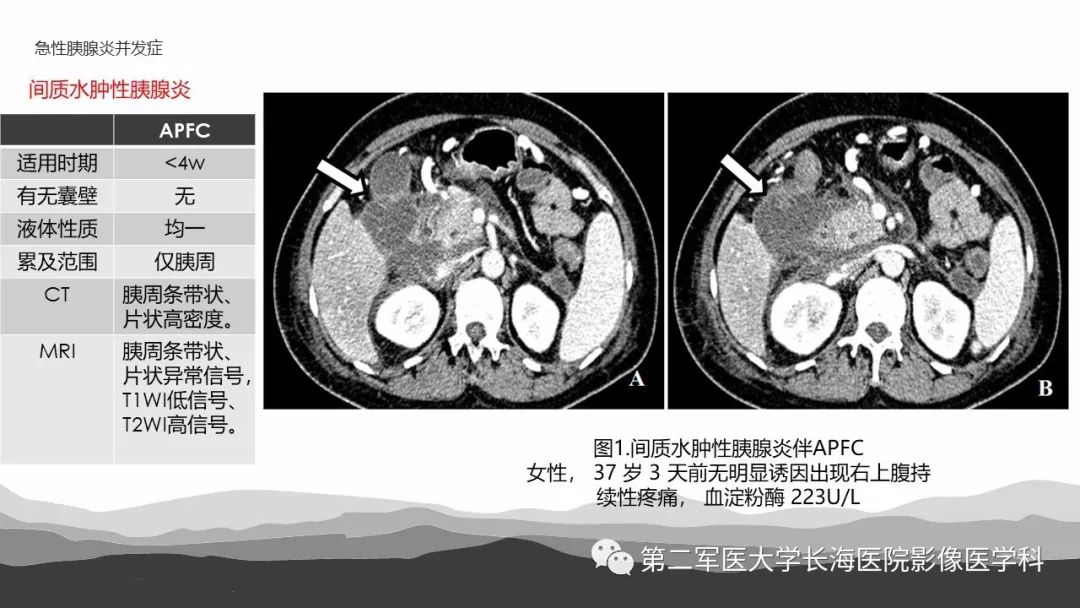 影像PPT - 【PPT】坏死性急性胰腺炎的影像，诊断，治疗-9