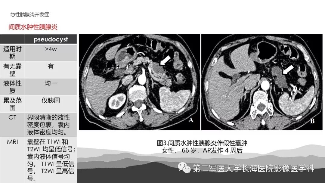影像PPT - 【PPT】坏死性急性胰腺炎的影像，诊断，治疗-11