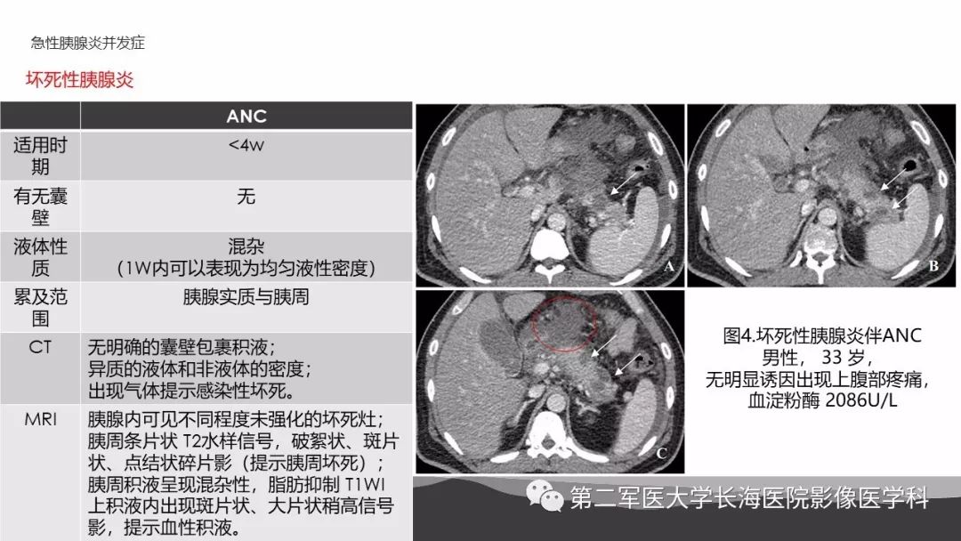 影像PPT - 【PPT】坏死性急性胰腺炎的影像，诊断，治疗-12
