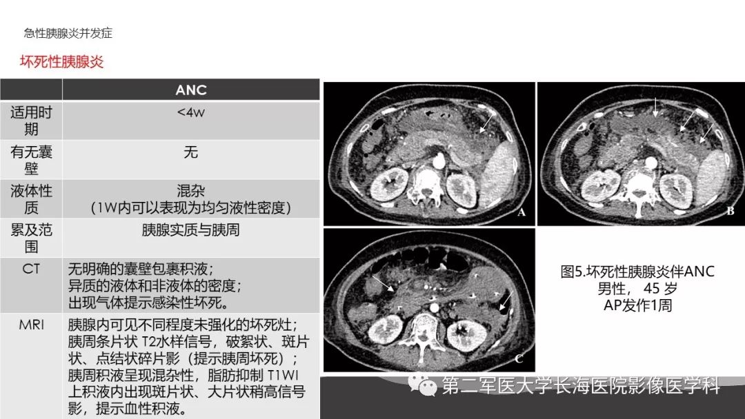 影像PPT - 【PPT】坏死性急性胰腺炎的影像，诊断，治疗-13