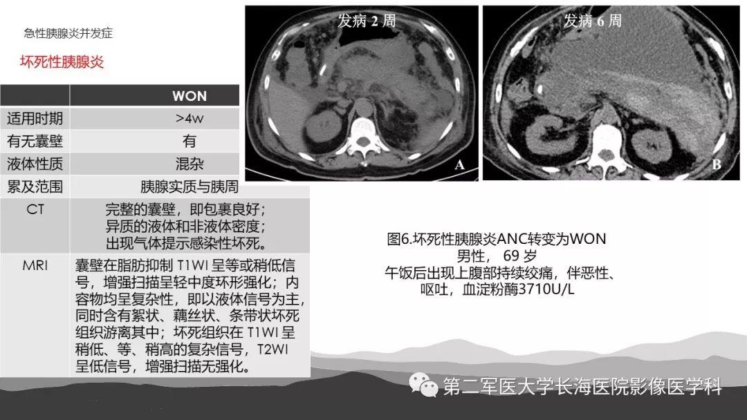 影像PPT - 【PPT】坏死性急性胰腺炎的影像，诊断，治疗-14