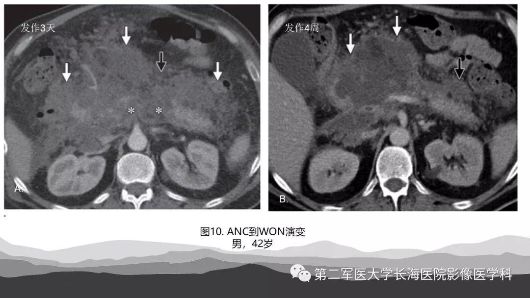 影像PPT - 【PPT】坏死性急性胰腺炎的影像，诊断，治疗-19