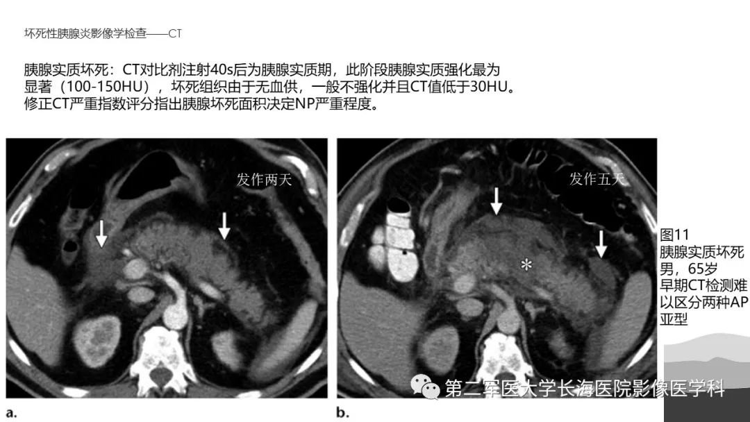 影像PPT - 【PPT】坏死性急性胰腺炎的影像，诊断，治疗-22