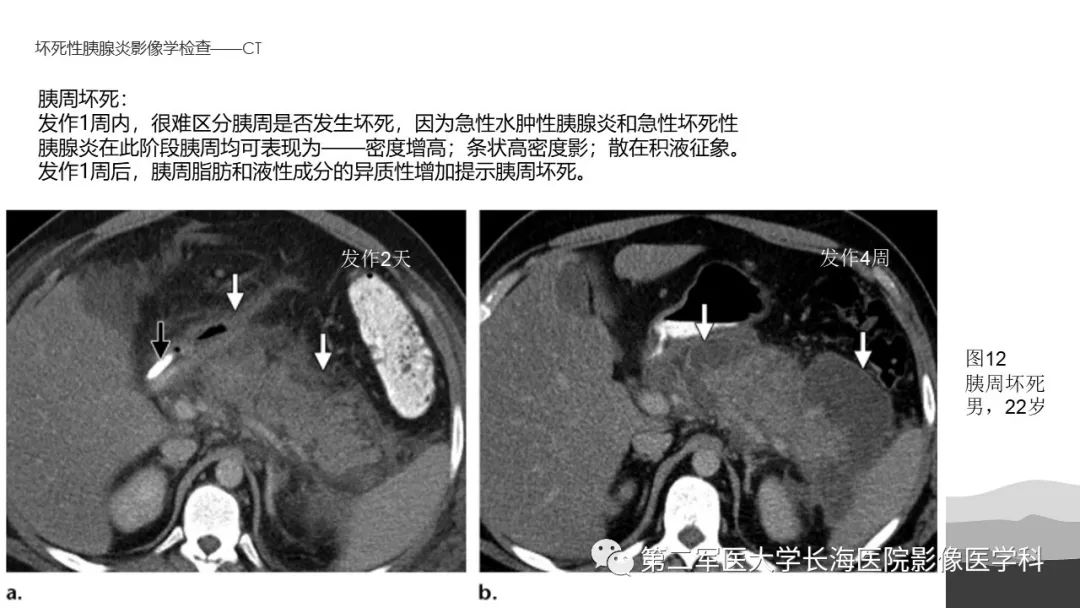 影像PPT - 【PPT】坏死性急性胰腺炎的影像，诊断，治疗-23