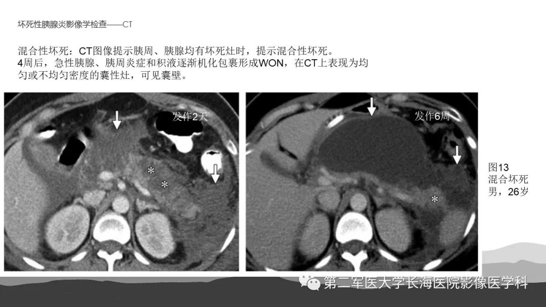 影像PPT - 【PPT】坏死性急性胰腺炎的影像，诊断，治疗-24