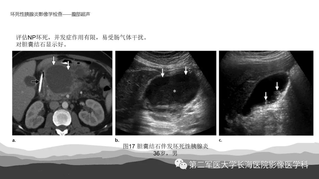 影像PPT - 【PPT】坏死性急性胰腺炎的影像，诊断，治疗-29