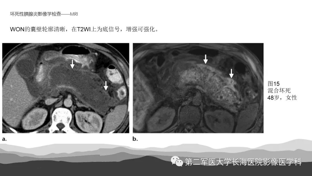 影像PPT - 【PPT】坏死性急性胰腺炎的影像，诊断，治疗-27