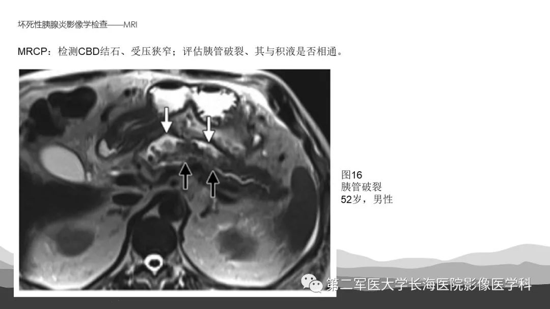 影像PPT - 【PPT】坏死性急性胰腺炎的影像，诊断，治疗-28