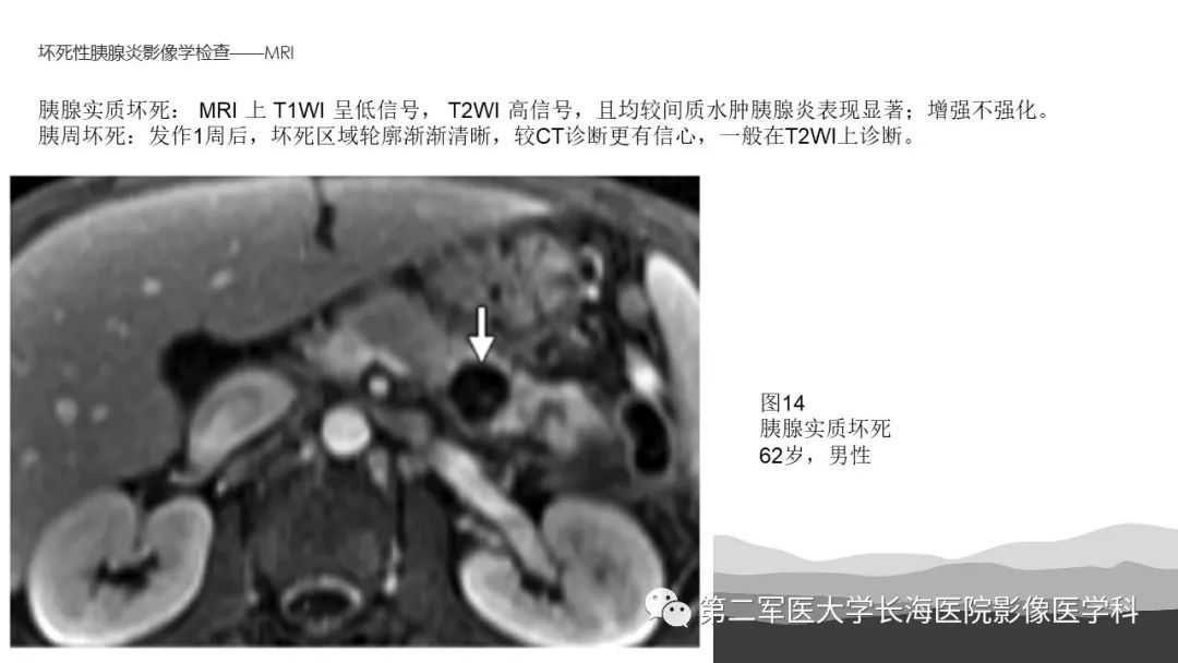 影像PPT - 【PPT】坏死性急性胰腺炎的影像，诊断，治疗-26