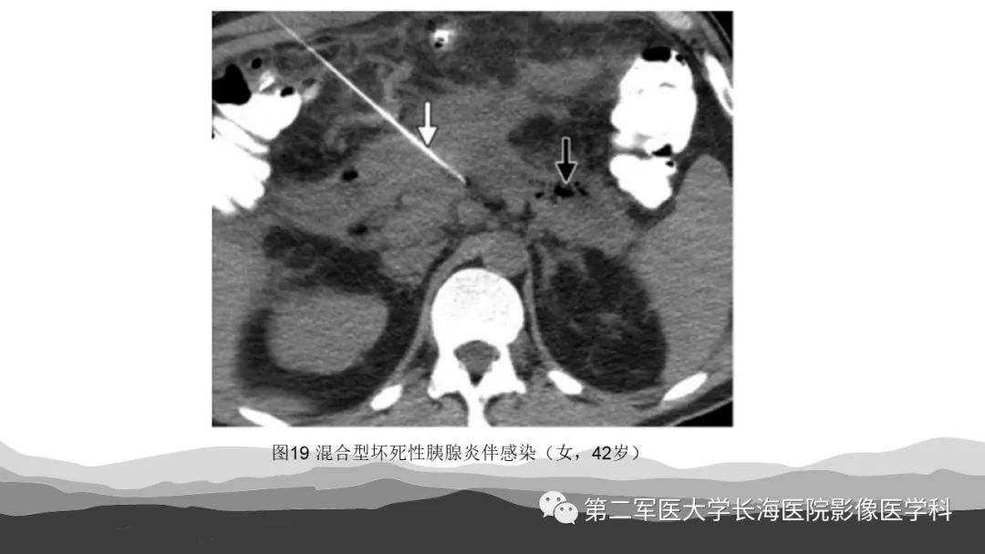 影像PPT - 【PPT】坏死性急性胰腺炎的影像，诊断，治疗-35