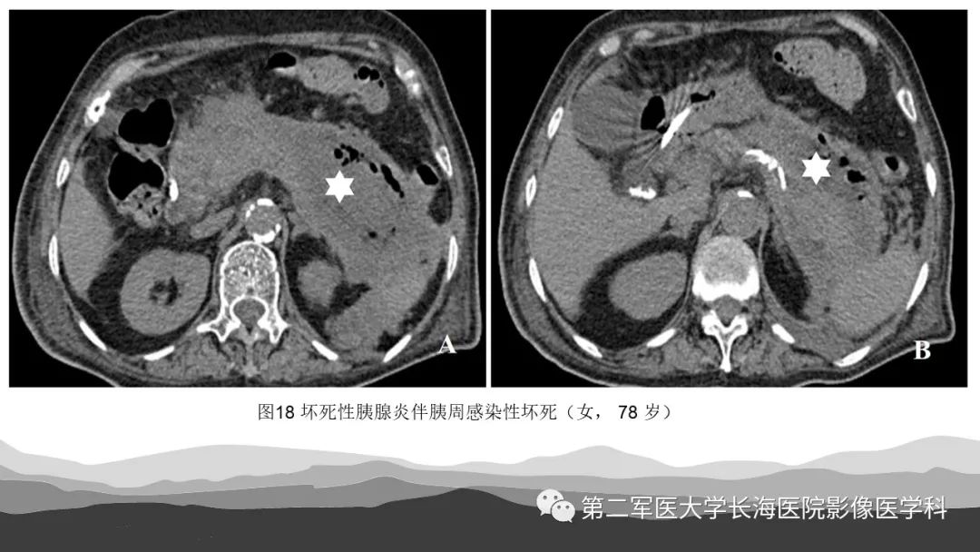 影像PPT - 【PPT】坏死性急性胰腺炎的影像，诊断，治疗-34