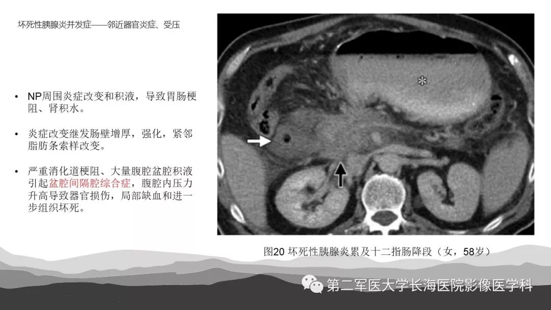 影像PPT - 【PPT】坏死性急性胰腺炎的影像，诊断，治疗-36