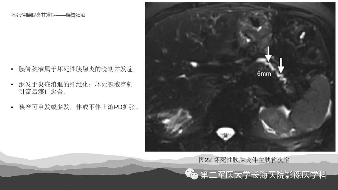 影像PPT - 【PPT】坏死性急性胰腺炎的影像，诊断，治疗-38