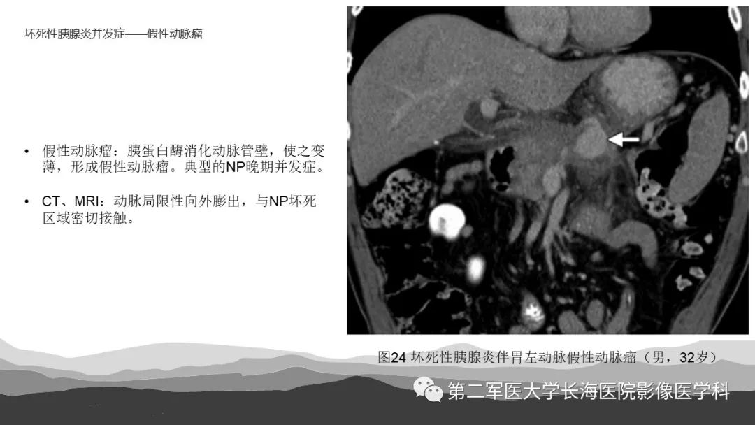 影像PPT - 【PPT】坏死性急性胰腺炎的影像，诊断，治疗-40