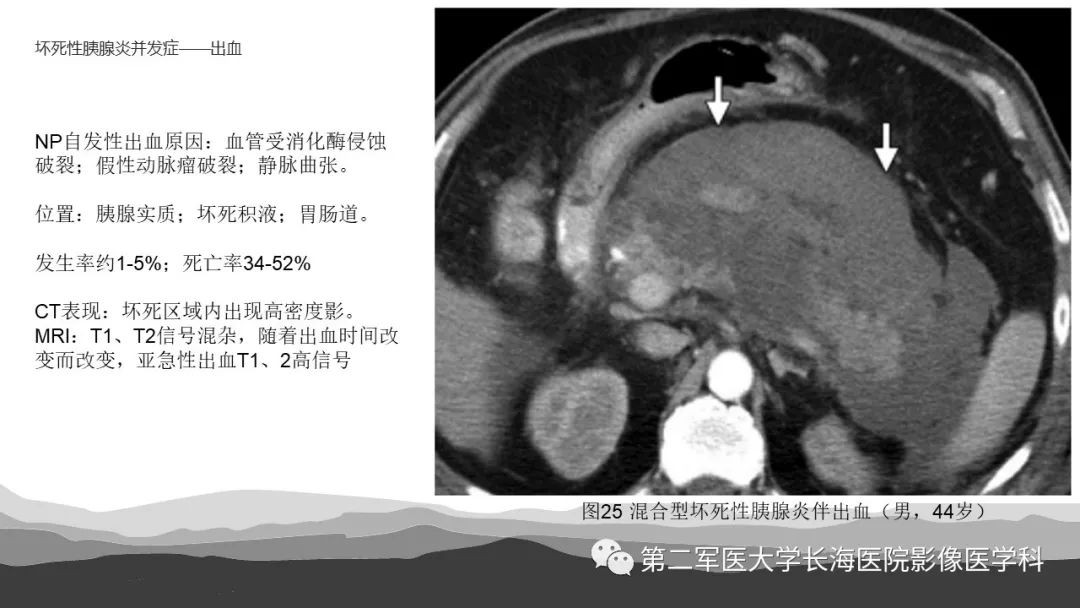 影像PPT - 【PPT】坏死性急性胰腺炎的影像，诊断，治疗-41