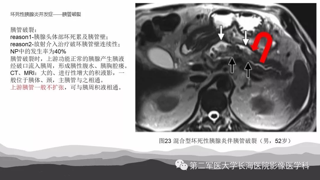 影像PPT - 【PPT】坏死性急性胰腺炎的影像，诊断，治疗-39