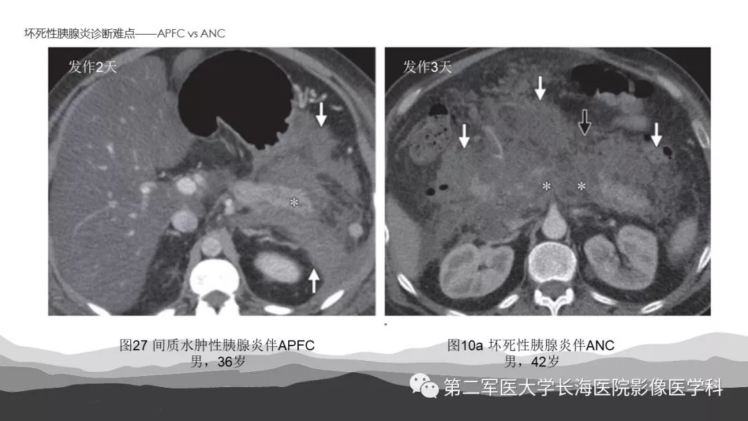 影像PPT - 【PPT】坏死性急性胰腺炎的影像，诊断，治疗-45