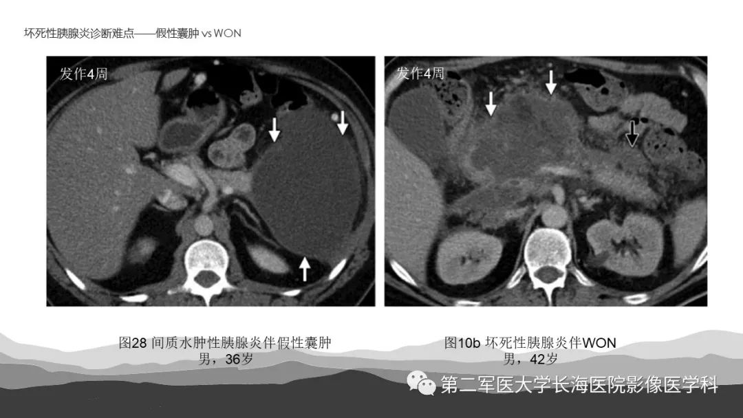 影像PPT - 【PPT】坏死性急性胰腺炎的影像，诊断，治疗-47