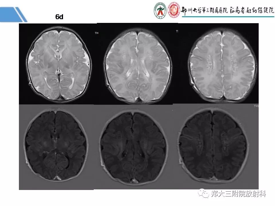 影像PPT - 【PPT】多系统平滑肌功能障碍综合征-4