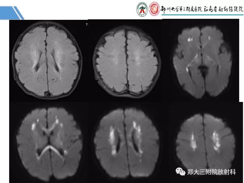 影像PPT - 【PPT】多系统平滑肌功能障碍综合征-5