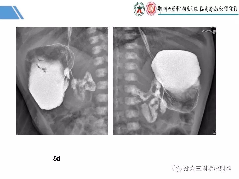 影像PPT - 【PPT】多系统平滑肌功能障碍综合征-6