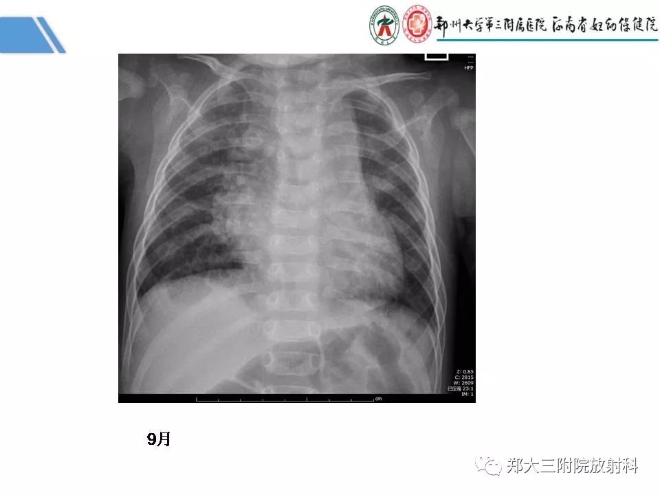 影像PPT - 【PPT】多系统平滑肌功能障碍综合征-8