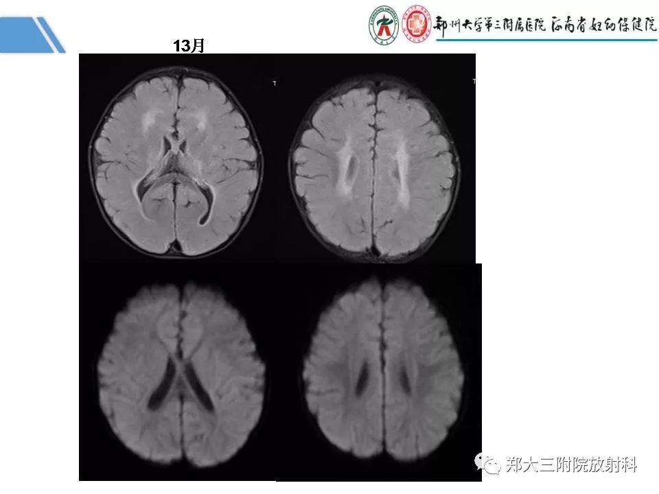 影像PPT - 【PPT】多系统平滑肌功能障碍综合征-11