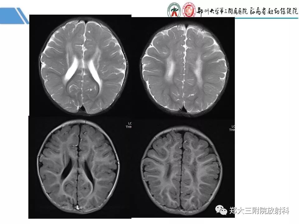 影像PPT - 【PPT】多系统平滑肌功能障碍综合征-10