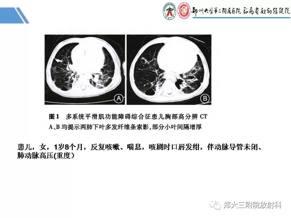 影像PPT - 【PPT】多系统平滑肌功能障碍综合征-19