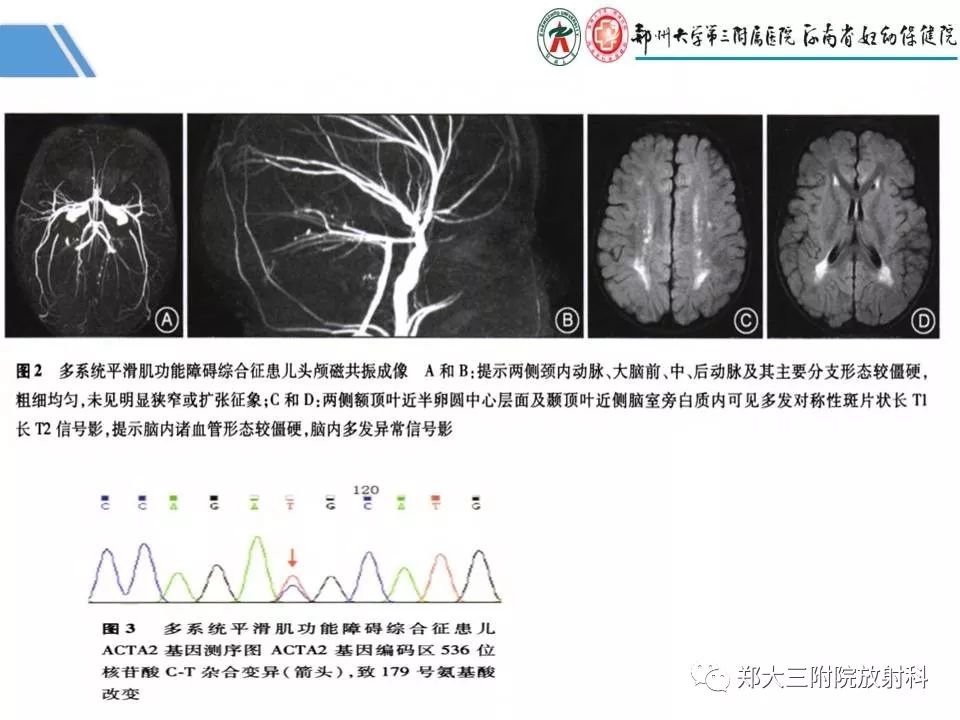 影像PPT - 【PPT】多系统平滑肌功能障碍综合征-20