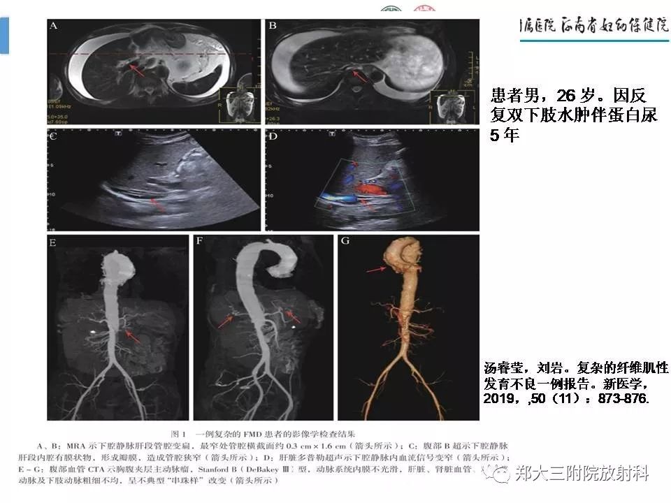 影像PPT - 【PPT】多系统平滑肌功能障碍综合征-29