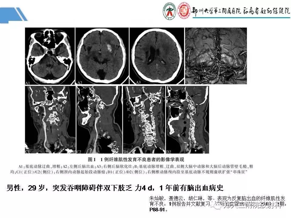 影像PPT - 【PPT】多系统平滑肌功能障碍综合征-30