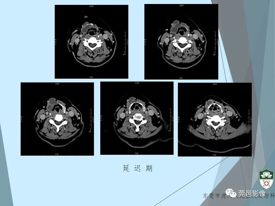影像PPT - 【PPT】甲状舌管囊肿的影像学诊断-11