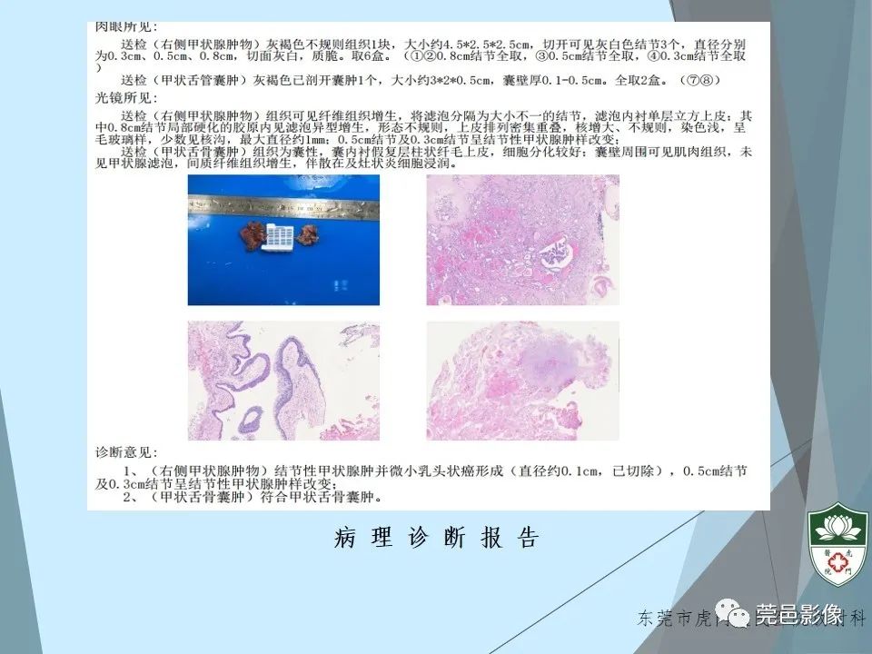 影像PPT - 【PPT】甲状舌管囊肿的影像学诊断-13