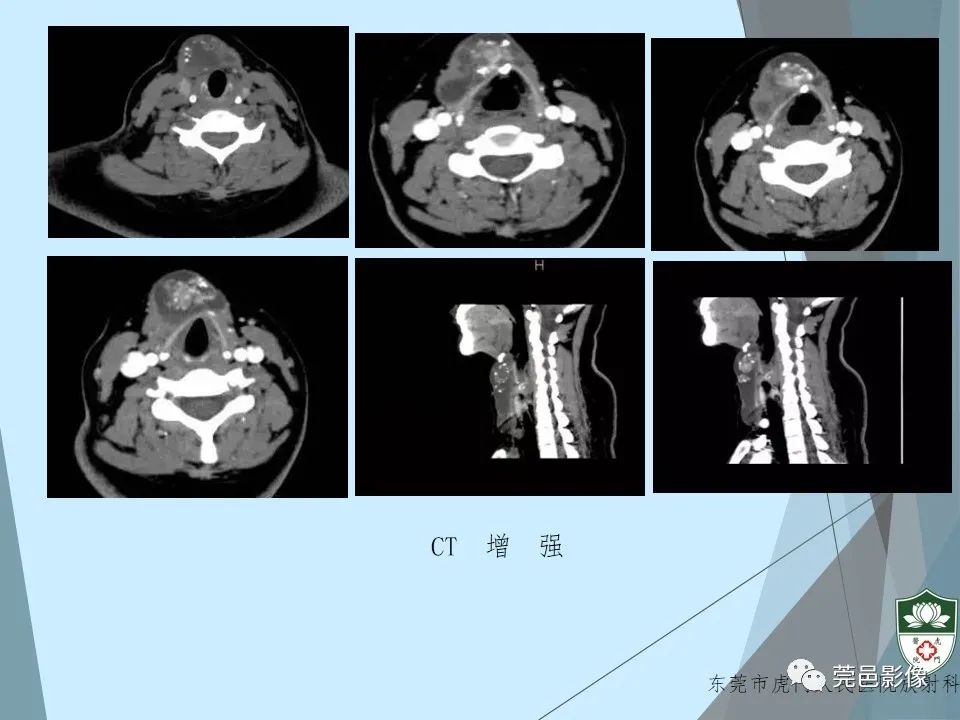 影像PPT - 【PPT】甲状舌管囊肿的影像学诊断-16