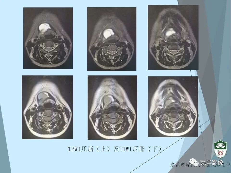 影像PPT - 【PPT】甲状舌管囊肿的影像学诊断-23