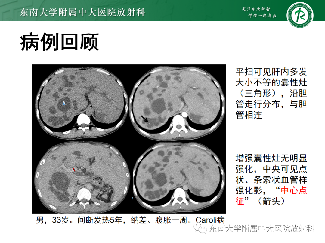 影像PPT - 【PPT】Caroli病-3 影像PPT - 【PPT】Caroli病-3