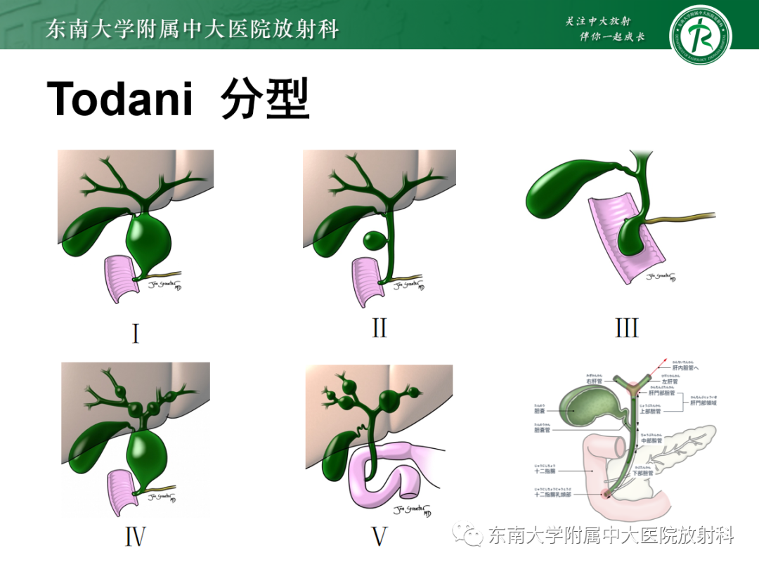 影像PPT - 【PPT】Caroli病-11 影像PPT - 【PPT】Caroli病-11