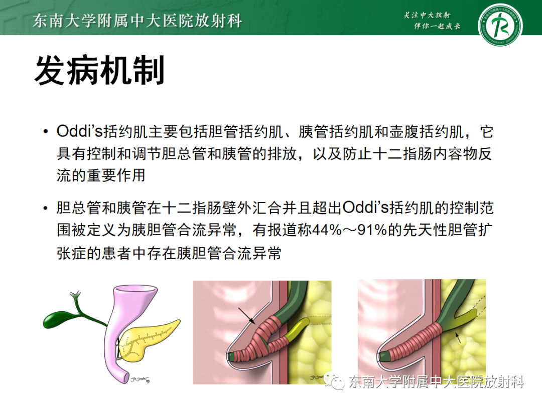 影像PPT - 【PPT】Caroli病-9 影像PPT - 【PPT】Caroli病-9