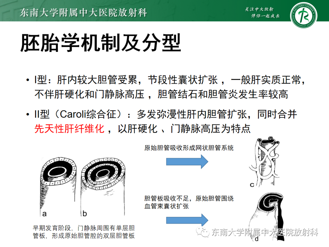 影像PPT - 【PPT】Caroli病-13 影像PPT - 【PPT】Caroli病-13