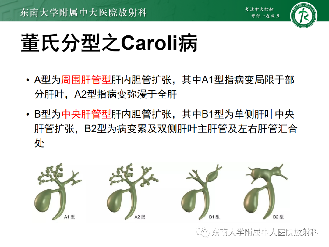 影像PPT - 【PPT】Caroli病-14 影像PPT - 【PPT】Caroli病-14