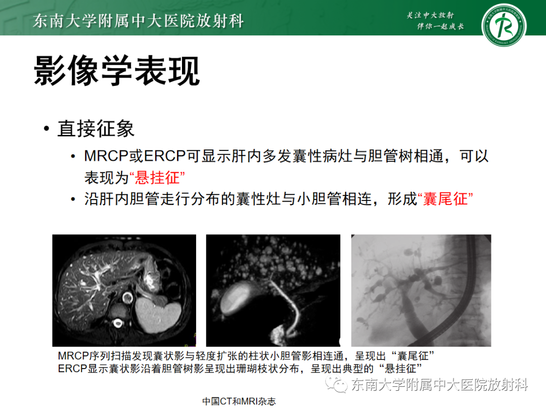 影像PPT - 【PPT】Caroli病-17 影像PPT - 【PPT】Caroli病-17