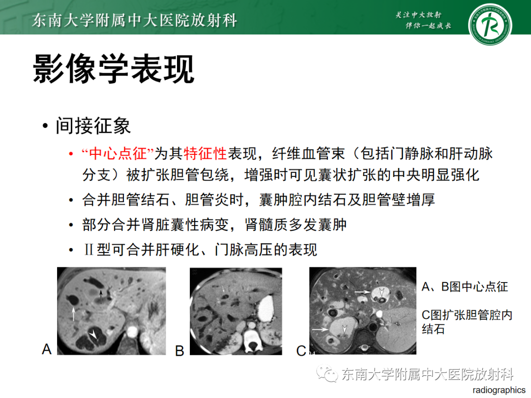 影像PPT - 【PPT】Caroli病-18 影像PPT - 【PPT】Caroli病-18